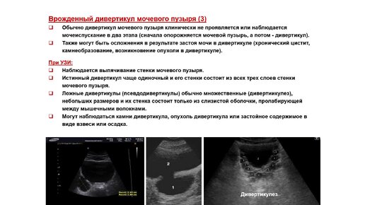 Ультразвуковая диагностика (УЗИ). Доктор Иогансен. Выпуск 97. Аномалии развития мочевого пузыря и нижних мочевых путей. Часть 3.