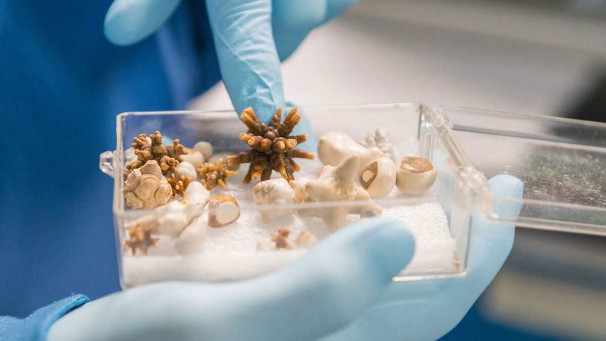 Мочевые камни