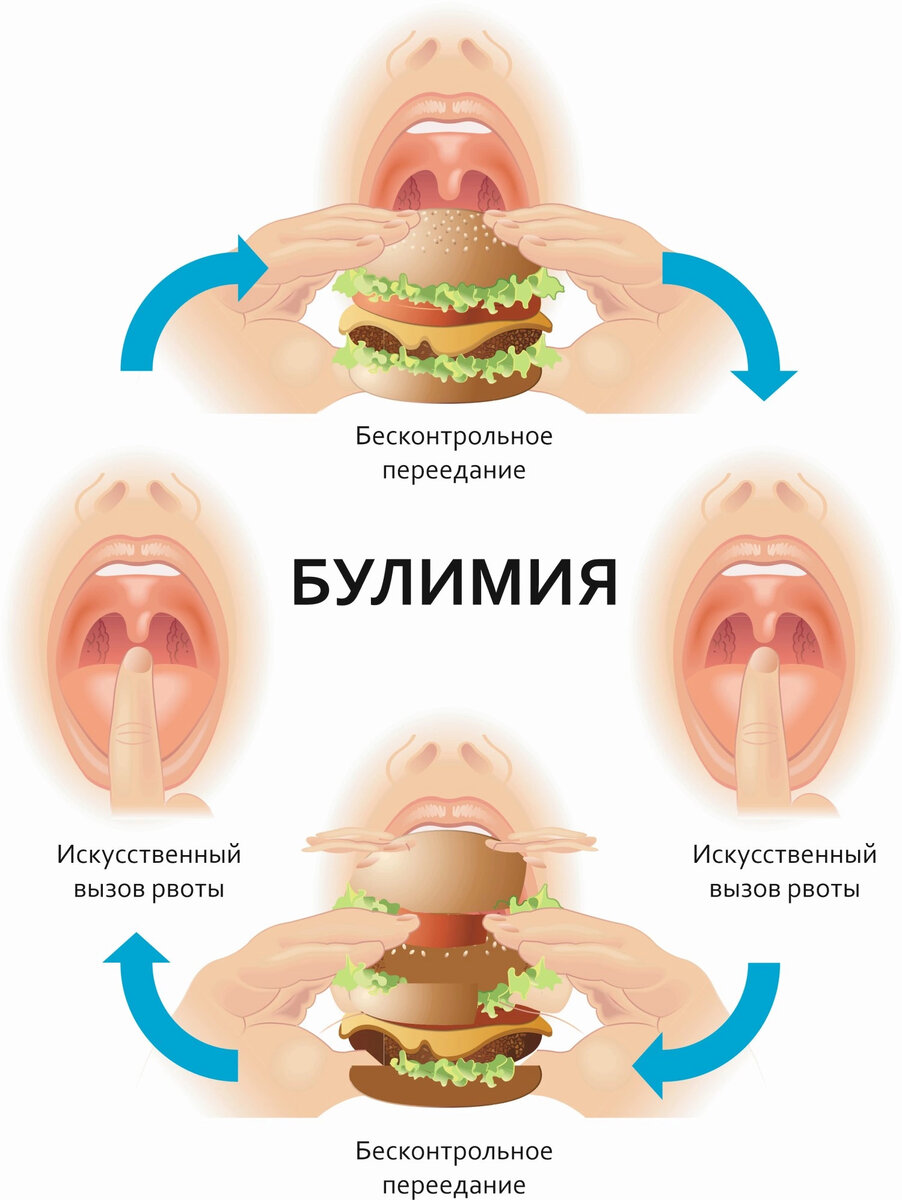 Булимия