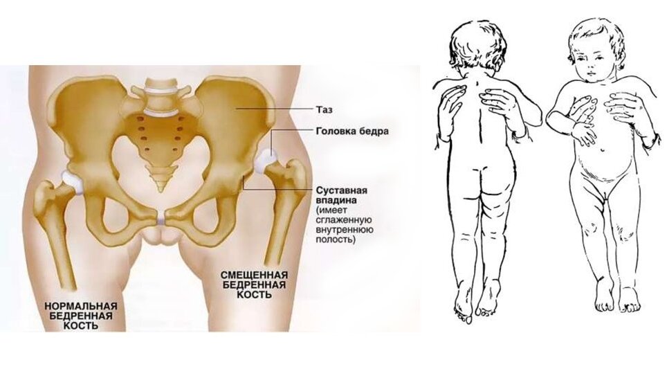 Симптом врожденного вывиха бедра у новорожденных. Врожденный подвывих тазобедренного сустава у детей. Дисплазия тазобедренных суставов у детей симптомы в 5 лет. Дисплазия тазобедренных суставов 5 лет.
