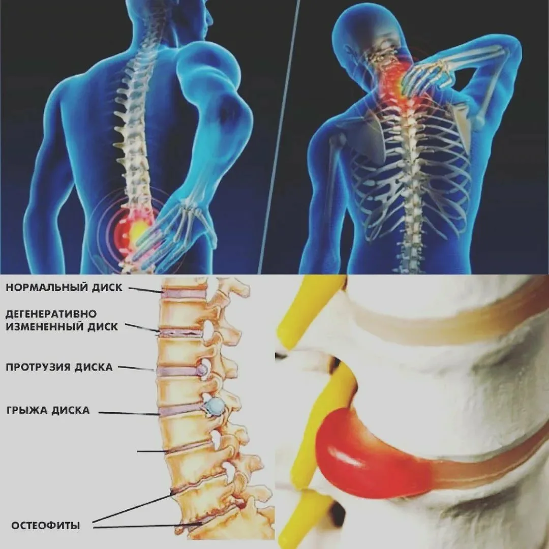 Межпозвоночная грыжа какие боли. Протрузия дисков позвоночника и грыжа диска. Протрузия дисков позвоночника что это такое. Грыжа диска и протрузия. Билатеральная протрузия межпозвоночного диска это.
