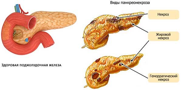 Стерильный панкреонекроз