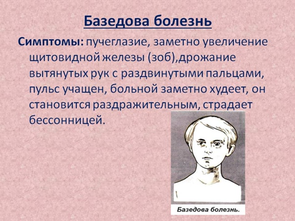 Симптомы заболевания базедовой болезни. Базедова болезнь симптомы. Клинические симптомы базедовой болезни. Базедова болезнь причины.