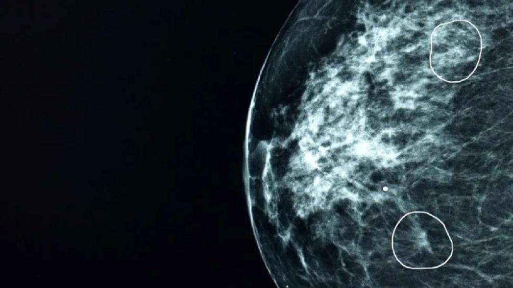 Система на основе искусственного интеллекта (ИИ), протестированная в Национальной службе здравоохранения Великобритании (NHS), успешно выявила крошечные признаки рака груди у 11 женщин, которые были