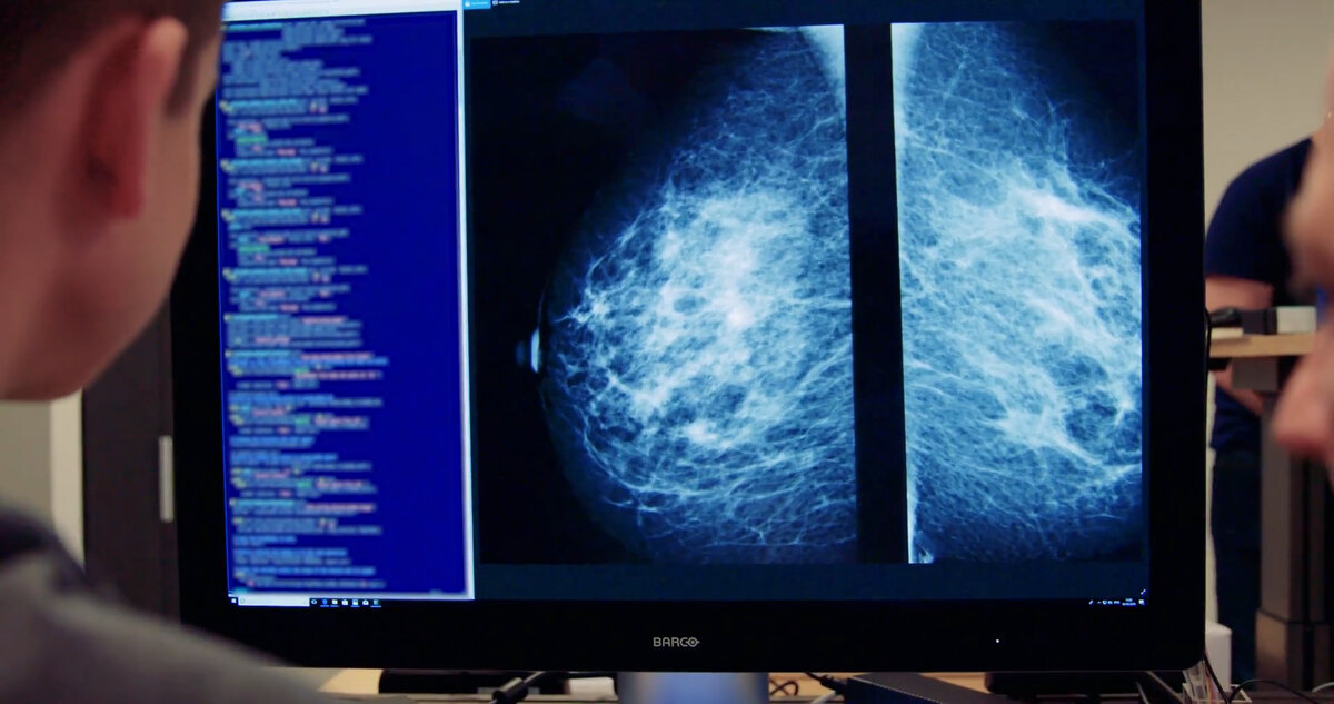 Система на основе искусственного интеллекта (ИИ), протестированная в Национальной службе здравоохранения Великобритании (NHS), успешно выявила крошечные признаки рака груди у 11 женщин, которые были-2