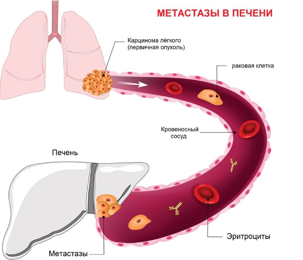 Метастазы: пути распространения раковых клеток в организме | Royal ...