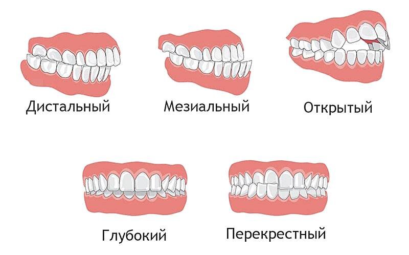 Виды патологий прикуса