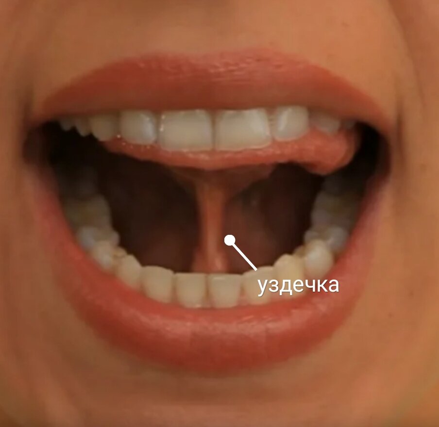 Если получается выполнить упражнения   "Лошадка", "Грибок", то длина уздечки нормальная, если нет, то стоит проконсультироваться со стоматологом