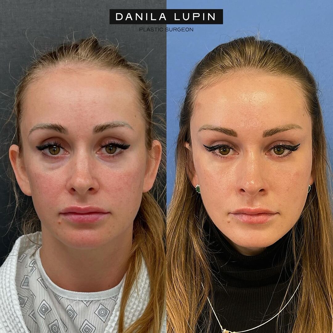 Лобно-височный лифтинг и липофилинг верхних, нижних век и скуловой и весочной области. На фото пациентка Данилы Лупина. Имеются противопоказания, необходима консультация специалиста. 