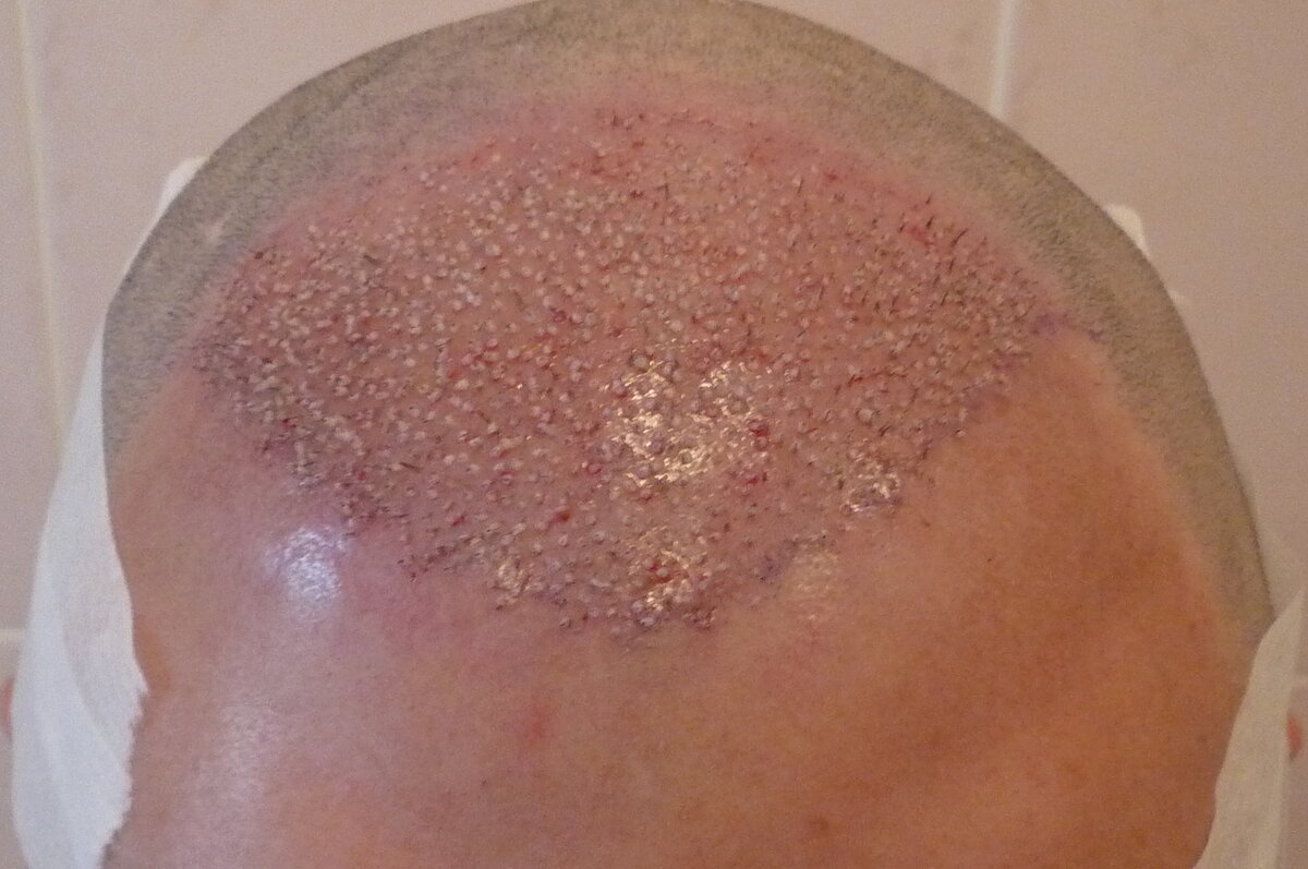 В области постановки есть небольшая припухлость, которая уходит спустя 3–5 дней