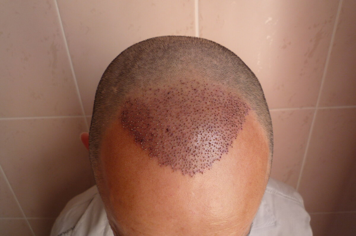 Через 3 дня микроранки заживают, образуются корочки