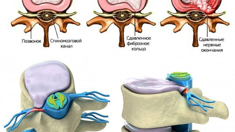 Резорбция межпозвонковой грыжи. Рассказываем что это такое.