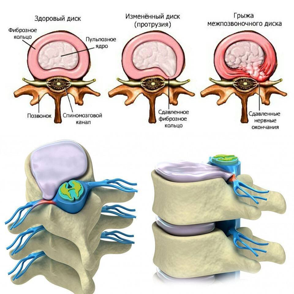 Межпозвонковая грыжа