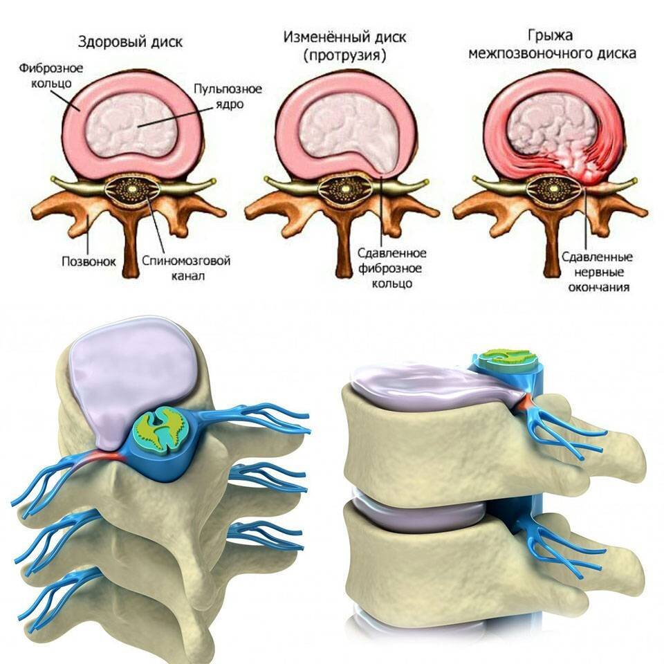 Межпозвоночная грыжа какие боли. Экструзия диска l5-s1 что это такое. Циркулярная протрузия дисков l4-s1. Циркулярная протрузия межпозвонкового диска l4-l5. Циркулярная протрузия межпозвонкового диска l1 l2.