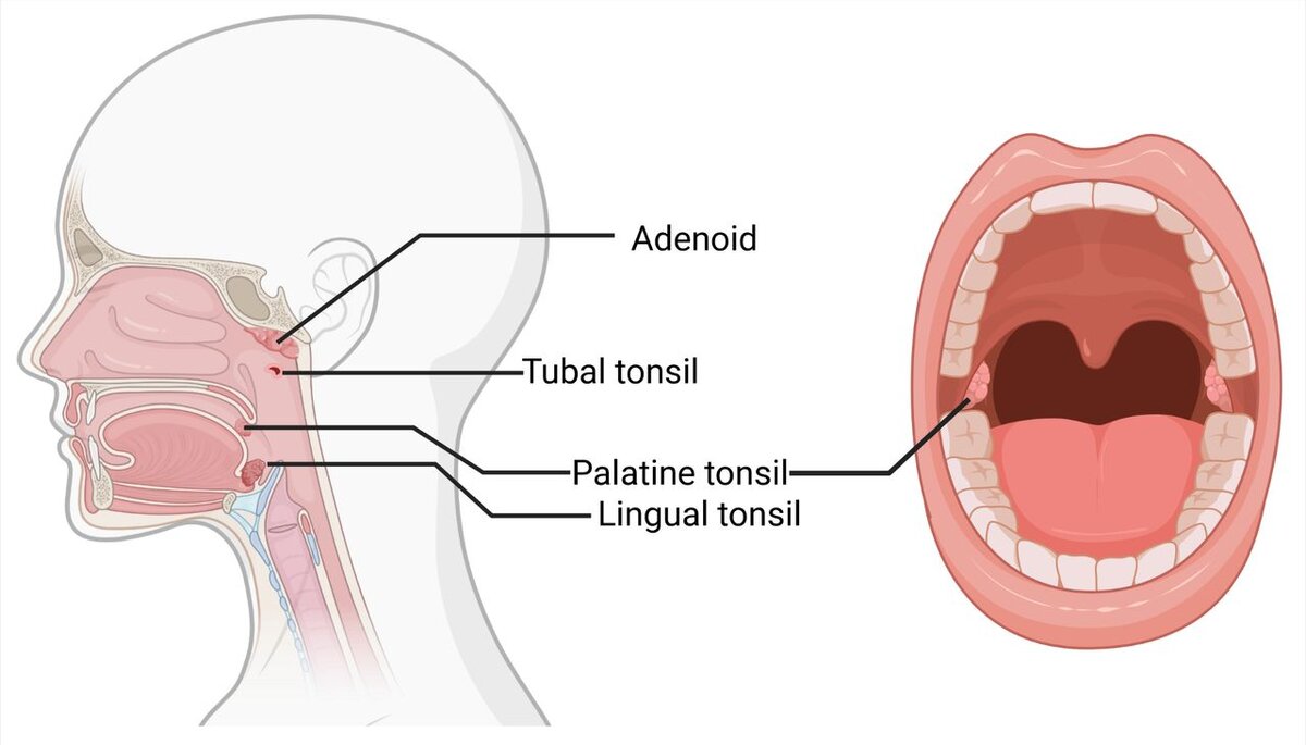 Трубные миндалины. Гипертрофия аденоидов и небных миндалин. Гипертрофия аденоидов у детей.