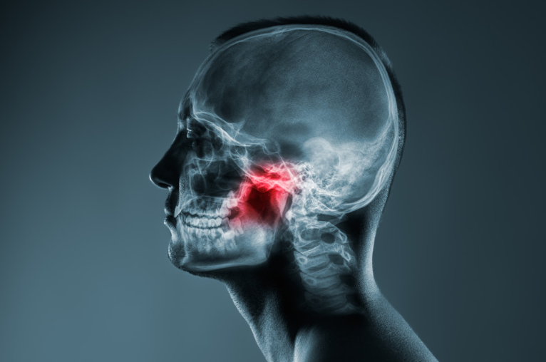 Остеонекроз челюсти на фоне терапии бисфосфонатами и моноклональными антителами