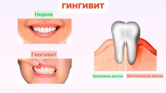 Лечение десен народными средствами