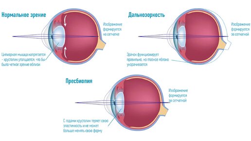 Пресбиопия ГЛАЗ: симптомы и лечение пресбиопии. Возрастная дальнозоркость и её коррекция
