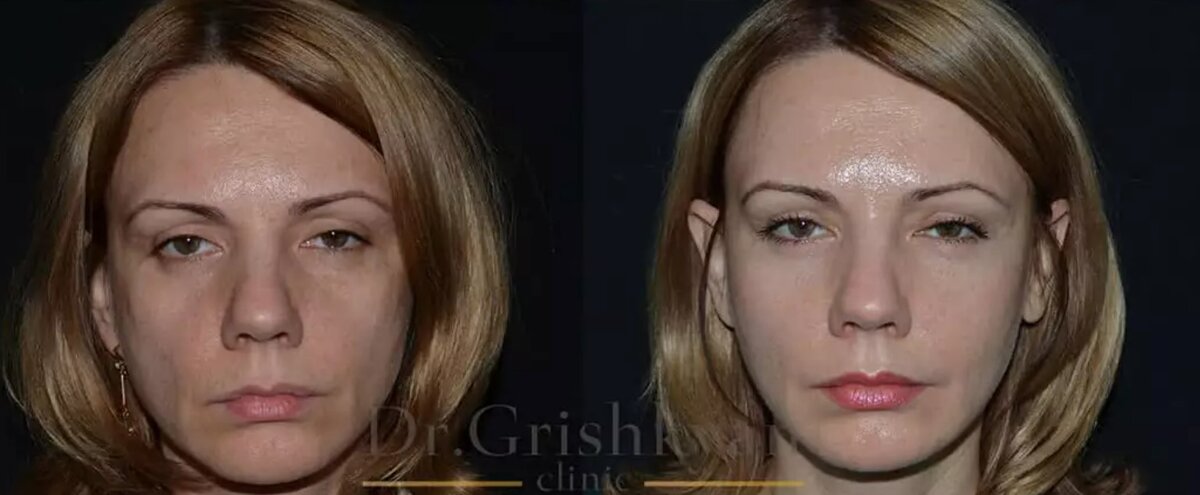 Кэндис свейнпол губы. Эмилин рошфей. Макияж болезненный вид. Яшкины впалые щеки беспокойные. Запали щеки в 40 лет фото.