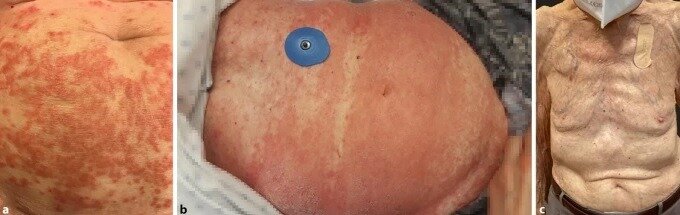 Клиническая картина в случае №2. Папулезные высыпания (а), прогрессирующие в эритродермию с симптомом "шезлонга" (B). Полное разрешение кожно-патологического процесса после комбинированного лечения системным ацитретином и местными кортикостероидами (с). 
Первоисточник - Blanchard, G., Guenova, E. Papuloerythroderma of Ofuji (PEO) successfully treated with acitretin. Allergo J Int 32, 151–153 (2023).  
https://link.springer.com/article/10.1007/s40629-022-00236-3