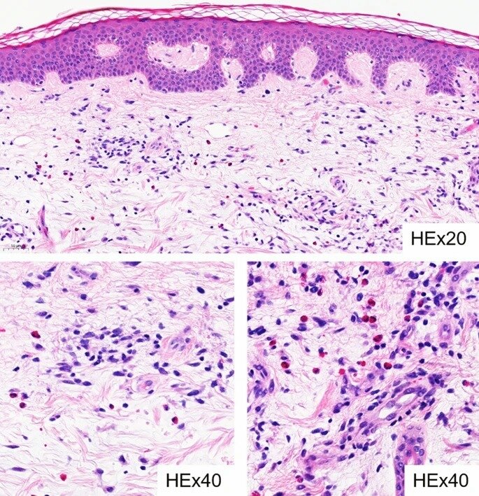 Гистологические признаки: неспецифический интерстициальный и периваскулярный дерматит с множественными эозинофилами. 
Первоисточник - Blanchard, G., Guenova, E. Papuloerythroderma of Ofuji (PEO) successfully treated with acitretin. Allergo J Int 32, 151–153 (2023).  
https://link.springer.com/article/10.1007/s40629-022-00236-3