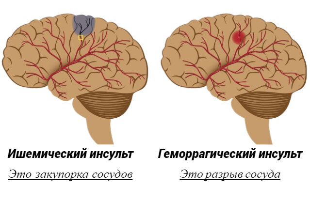 на картинке мы видим два вида инсульта 