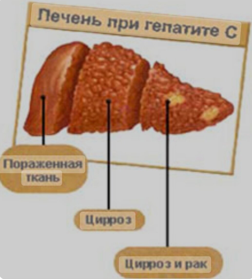 ИНФЕКЦИОННЫЕ ЗАБОЛЕВАНИЯ.