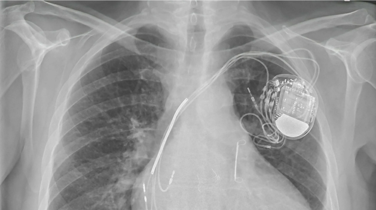 История кардиостимуляторов – это история борьбы за жизнь.-2