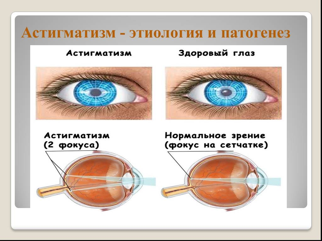 Астигматизм фото глаза