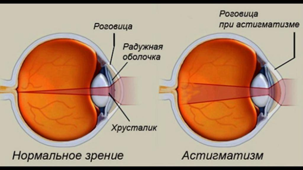 Как выглядит астигматизм глазами человека