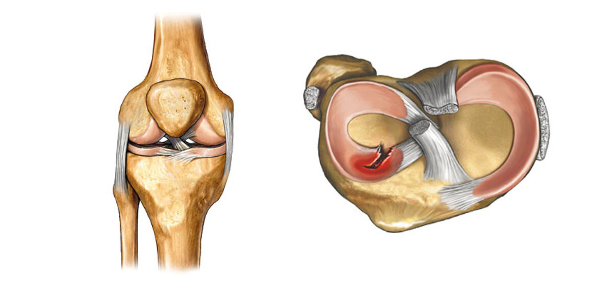 Разрыв заднего рога медиального мениска. 