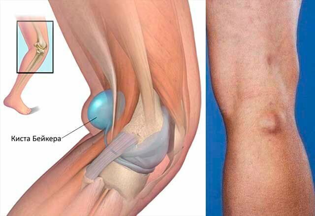 Киста Бейкера коленного сустава: симптомы и лечение