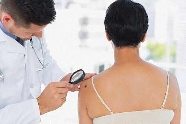    Что за метод АККОРД для проверки родинки на меланому?