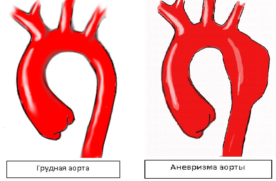 Аневризма аорты сколько живут. Аневризма грудной аорты. Аневризмы нисходящей грудной аорты. Аневризматическое расширение грудного отдела аорты.