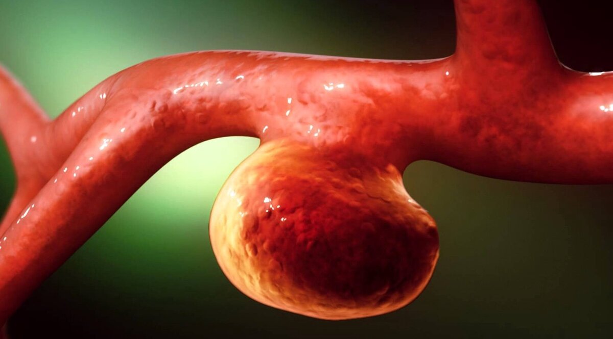 Аневризма мозговой артерии на широком основании