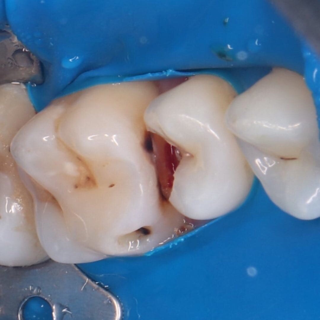 5 мест на зубах, где чаще всего возникает кариес. | Стоматологическая ...