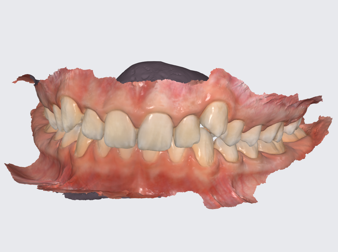 Исправление прикуса на элайнерах - дорого и не эффективно. Миф, в ...