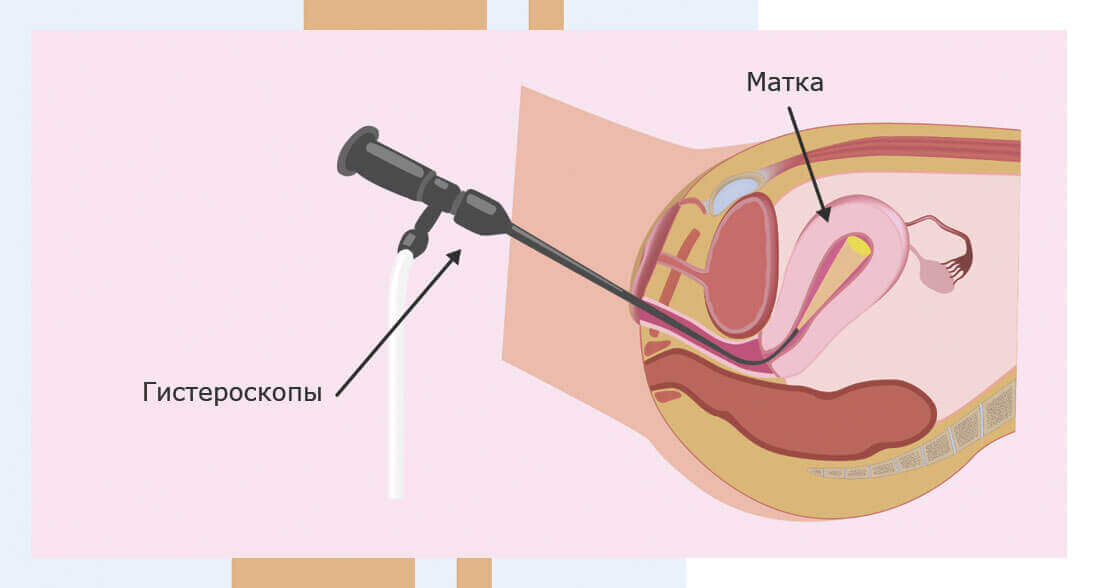 Гистероскопия
