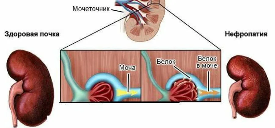 Как понять результаты анализа мочи?