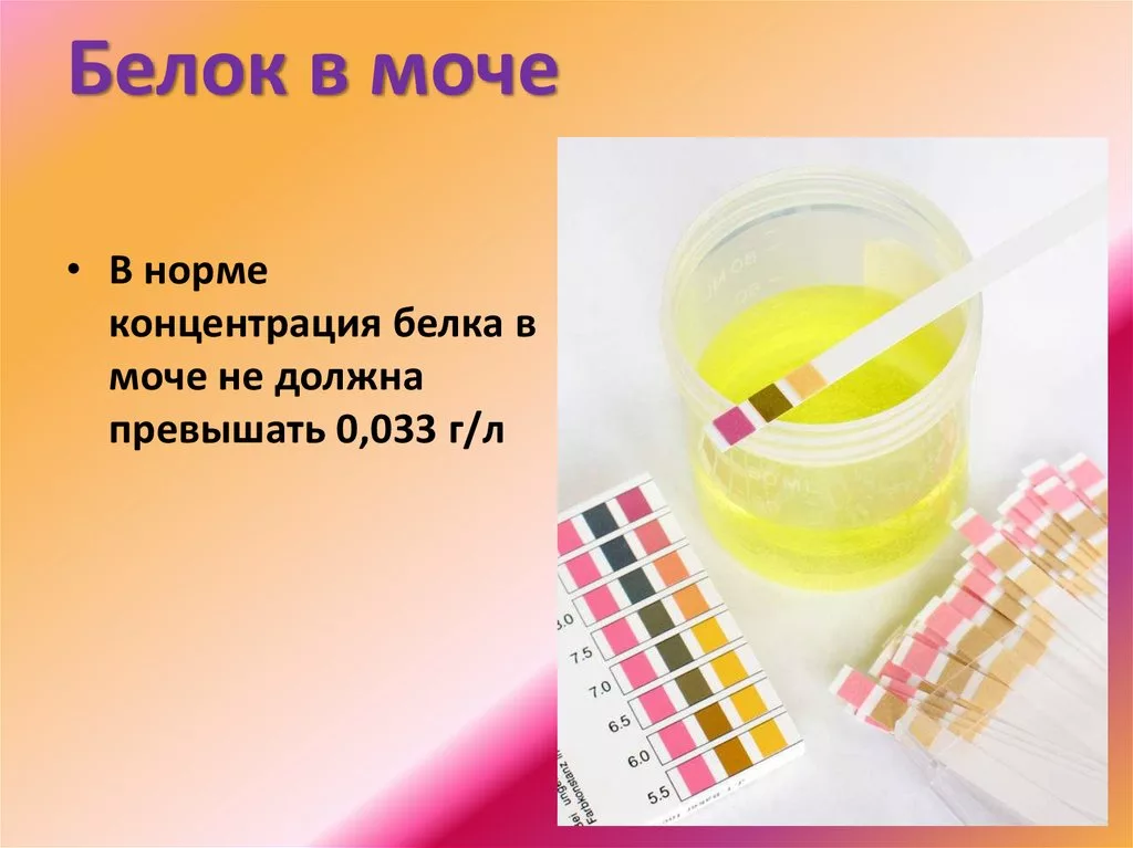 Белок в моче 17. Белок в моче. Белок в моче появляется при. Повышение белок в моче это. ,TKR D vjxt.