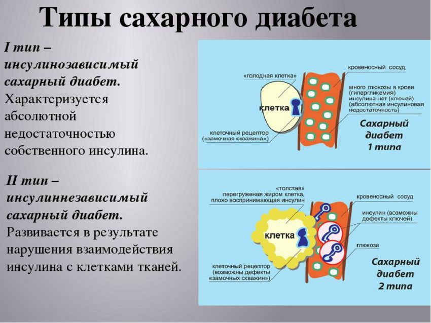 Диабет 1 типа механизм. Причины сахарного диабета 1 и 2 типа. Второй Тип диабета инсулин. Для сахарного диабета 1 типа характерно.