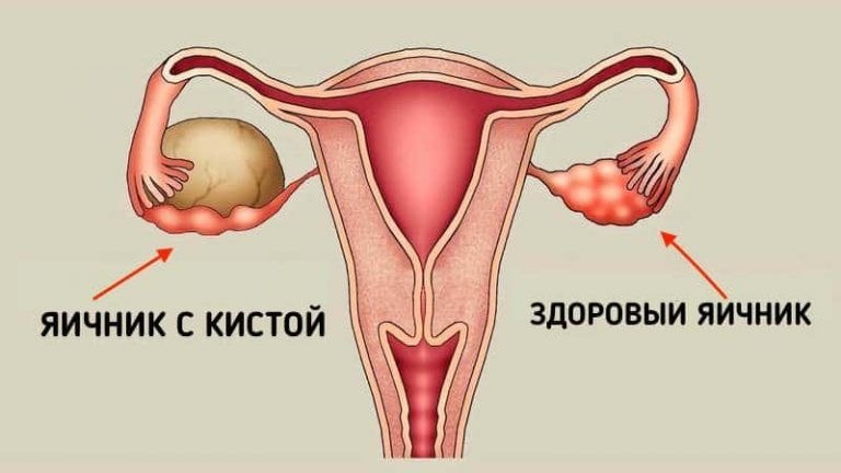 Киста яичников: в чем опасность?
