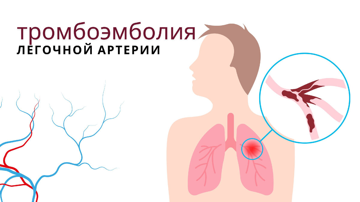 Тромбоэмболия легочной артерии - состояние, когда тромб перекрывает просвет главного сосуда, обеспечивающего обмен кислорода в организме. Нередко заболевание бывает молниеносно смертельным. 