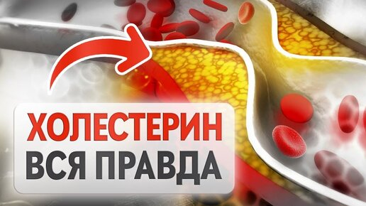 Как ГАРАНТИРОВАННО снизить высокий холестерин? ТОП-4 причин повышения ХОЛЕСТЕРИНА.