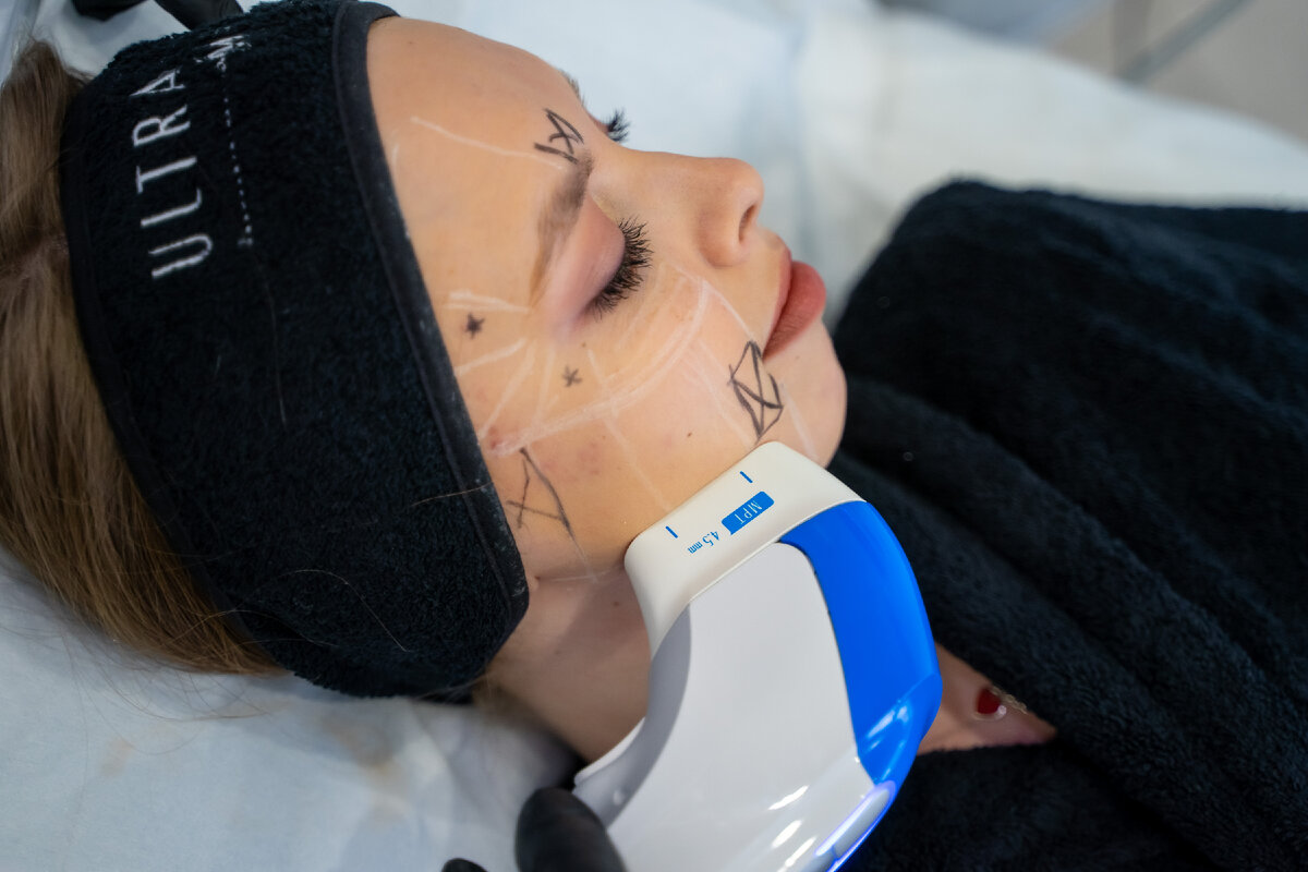 SMAS лифтинг Ultraformer MPT в сети клиник инновационной косметологии GEN87 