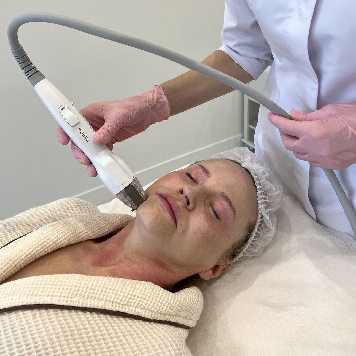 Как проходит микроигольчатый РФ лифтинг Virtue? Этап - обработка кожи микроиглами | сеть клиник косметологии GEN87