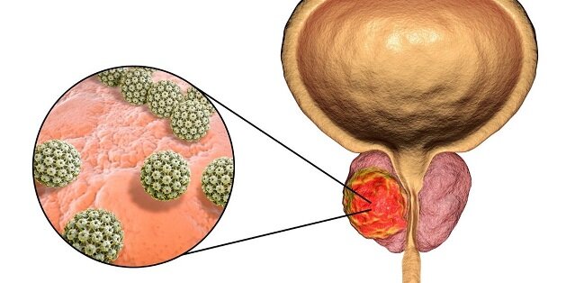Рак предстательной железы вызывает серьезные нарушения и снижение качества жизни