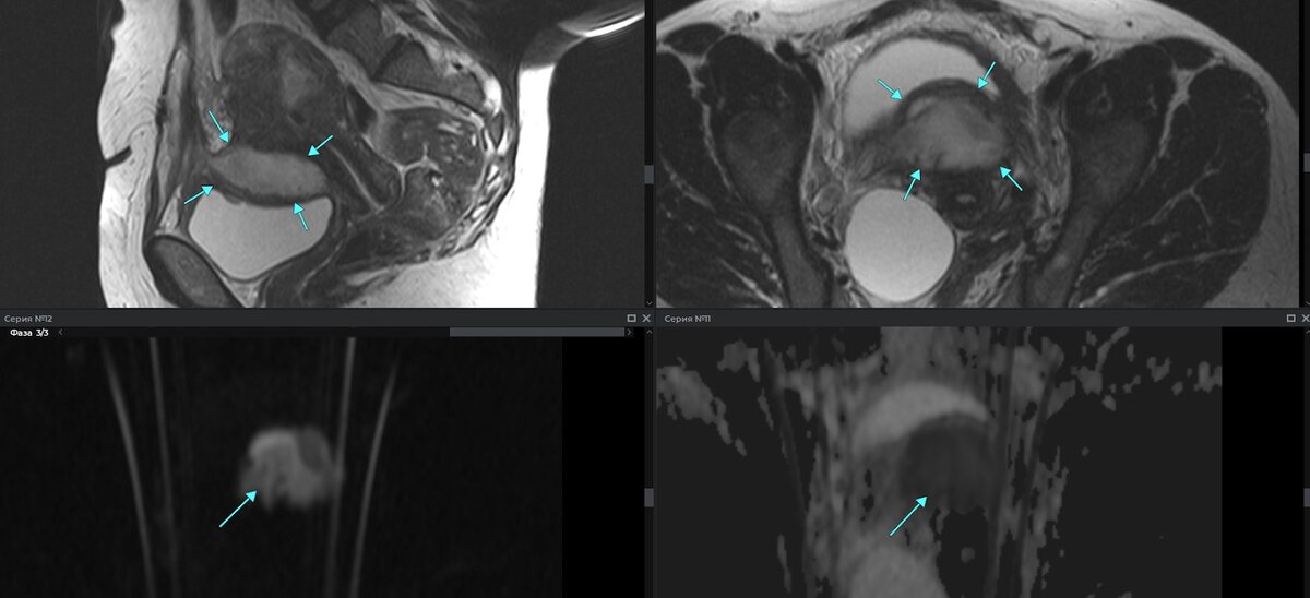 Рис. 1. Т2 сагиттальная плоскость и Т2 аксиальная плоскость [верхний ряд, слева направо], DWI (b-1000) и ADC карта [нижний ряд, слева направо]. Стрелками указано толстостенное образование между мочевым пузырем и маткой, с признаками истинного ограничения диффузии по DWI и снижения по ADC карте от содержимого.