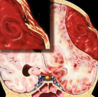 Рис. 1. Схематичное изображение эпидуральной гематомы