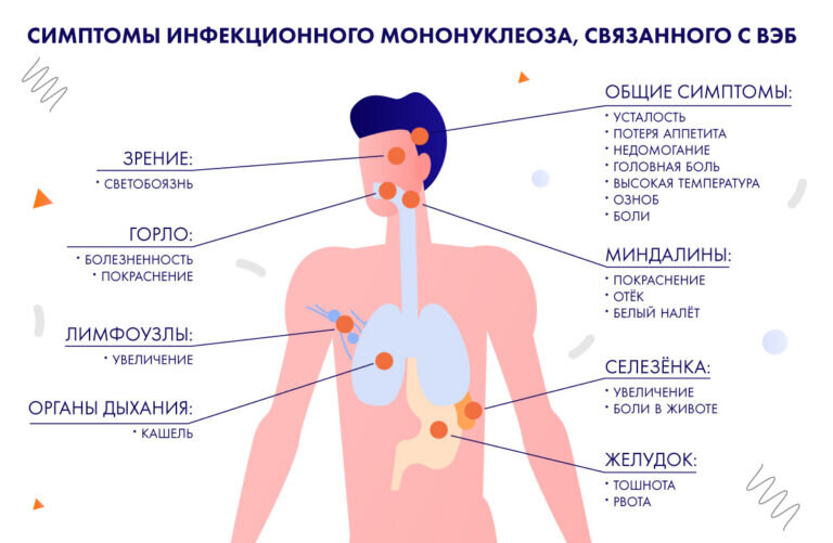 Признаки эпштейна барра